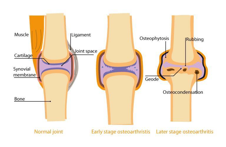 Osteoarthritis Explain the