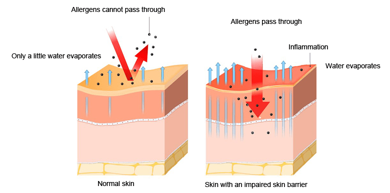 Atopic dermatitis